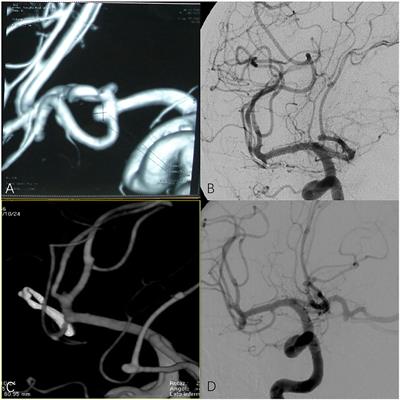 Keyhole Approach for Clipping Anterior Circulation Aneurysms: Clinical Outcomes and Technical Note